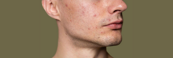 Ever wondered how Hormones and Diet Impact Acne?