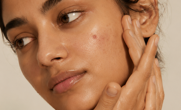 How to Prevent Pimples on Face Naturally