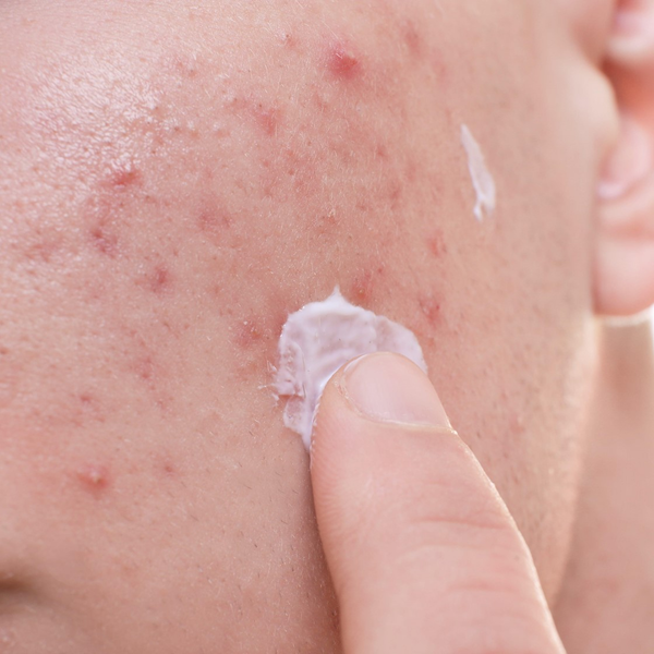 Clascoterone Cream 1% : the Next Generation of Acne Therapeutics
