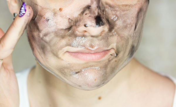 How to Get Rid of Black Pimples Naturally: What Really Helps