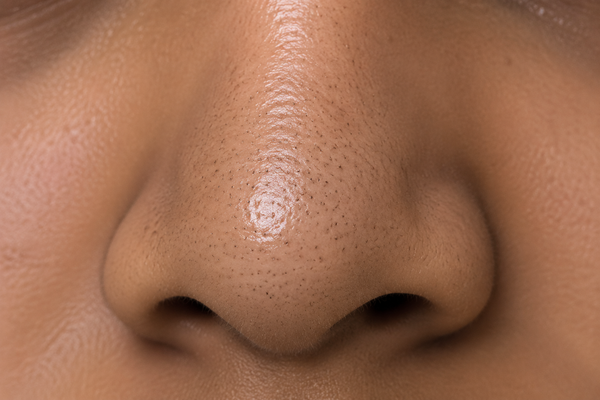 Black Pimples on Face: Causes & Effective Removal Methods