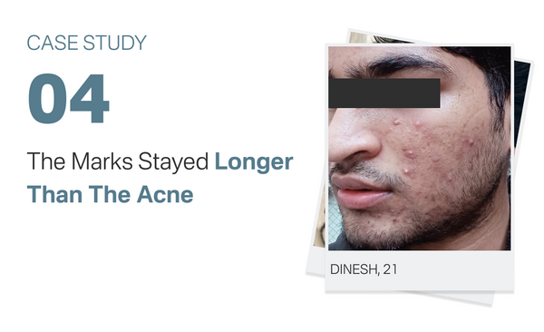 The Marks Stayed Longer Than The Acne
