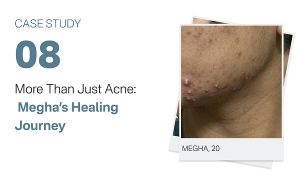 More Than Just Megha Acne Healing  Journey