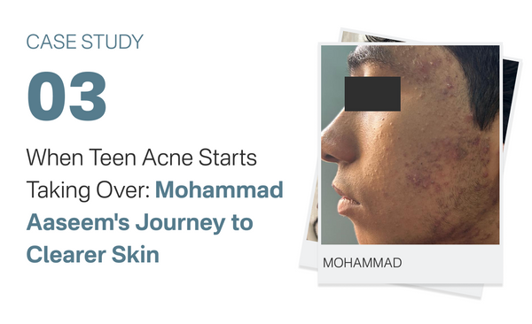 When Teen Acne Starts Taking Over: Mohammad Aaseem's Journey to Clearer Skin