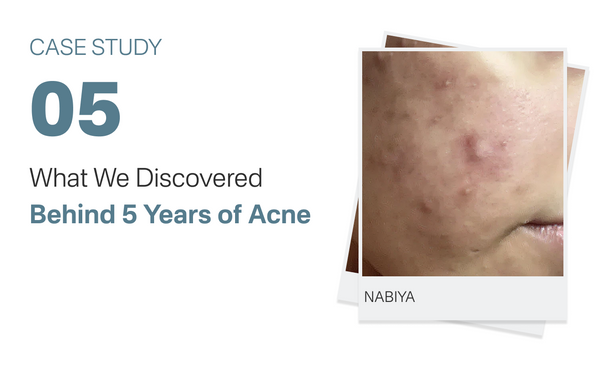 What We Discovered Behind 5 Years of Acne