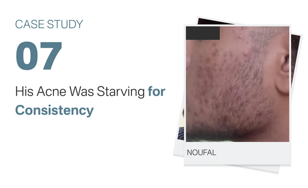 Noufal Kuttipencil Acne Was Starving  Acne Was Starving for Consistency