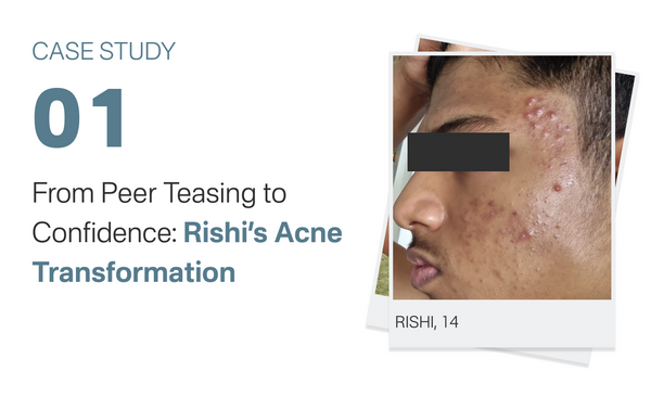 From Peer Teasing to Confidence: Rishi’s Acne Transformation