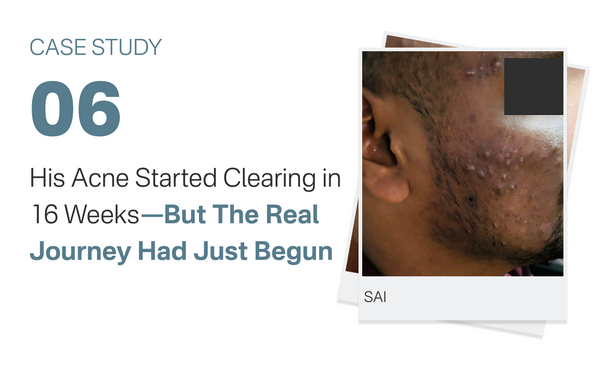 His Acne Started Clearing in 16 Weeks—But The Real Journey Had Just Begun
