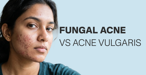 Fungal acne vs Acne vulgaris: spot the difference & treat it right