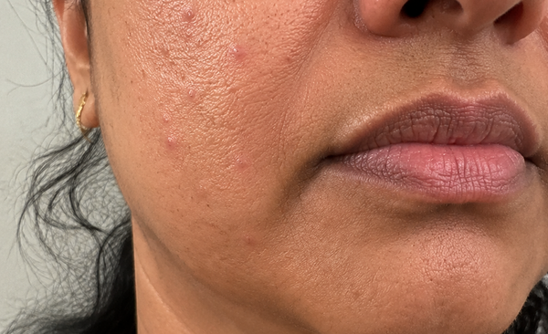 Raised Red Bumps on Skin