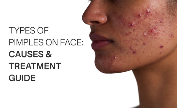 Types of Pimples on Face: Causes & Treatment Guide